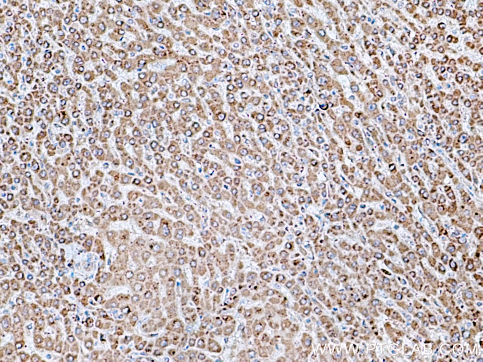 Immunohistochemistry (IHC) staining of human liver cancer tissue using ACSM5 Polyclonal antibody (16591-1-AP)