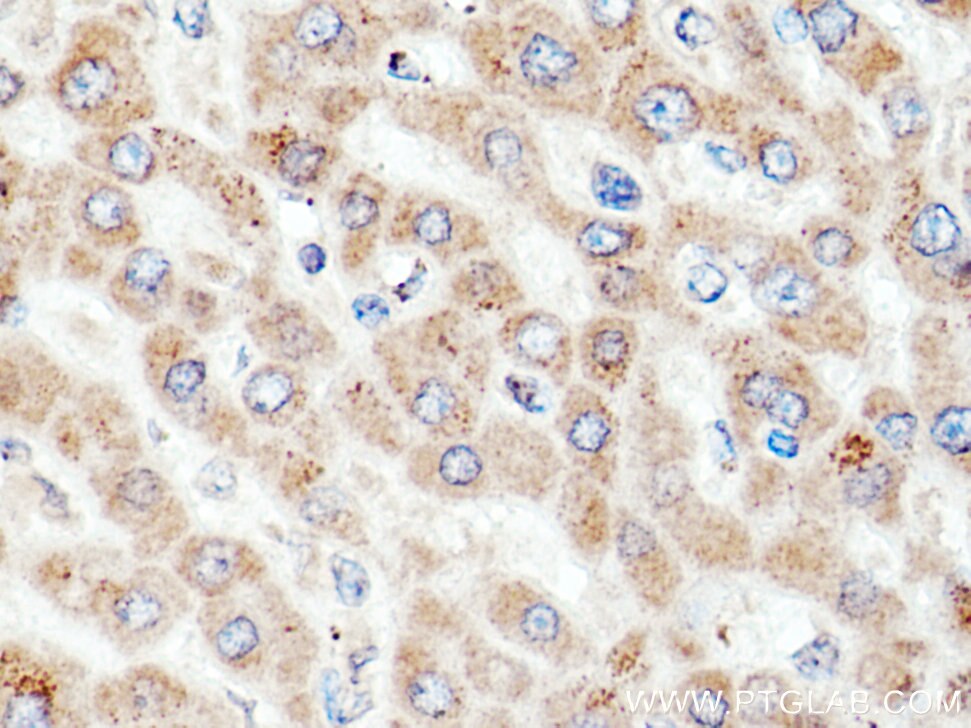 Immunohistochemistry (IHC) staining of human liver cancer tissue using ACSM5 Polyclonal antibody (16591-1-AP)