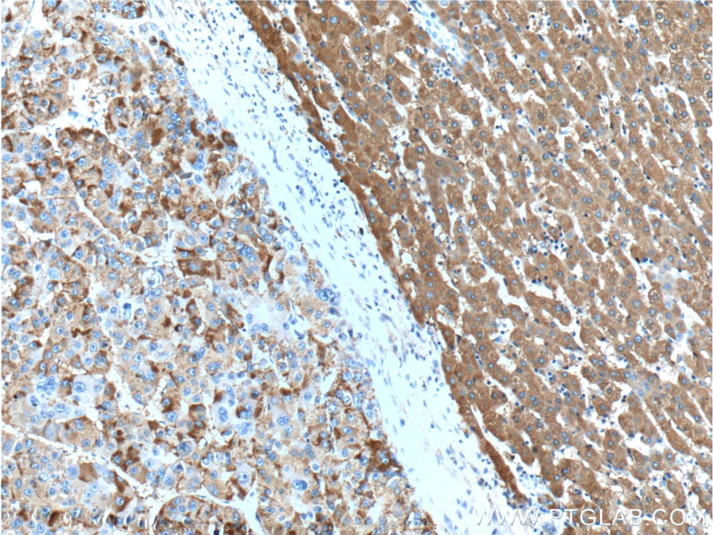 Immunohistochemistry (IHC) staining of human liver cancer tissue using ACSM5 Polyclonal antibody (16591-1-AP)