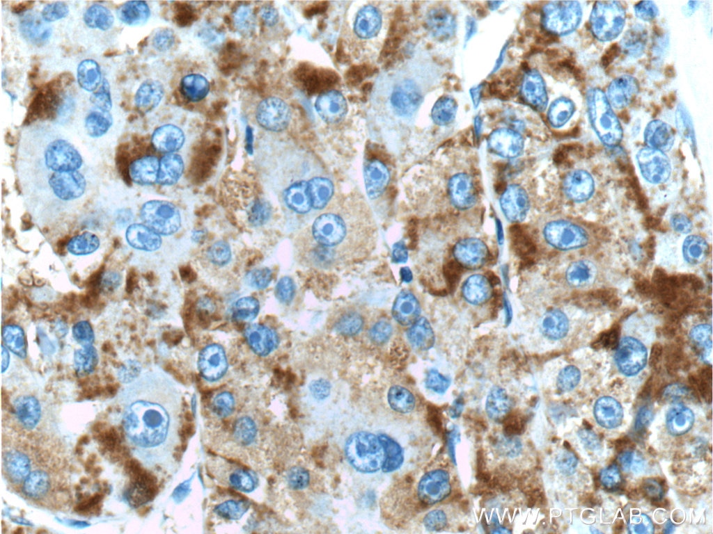 Immunohistochemistry (IHC) staining of human liver cancer tissue using ACSM5 Polyclonal antibody (16591-1-AP)