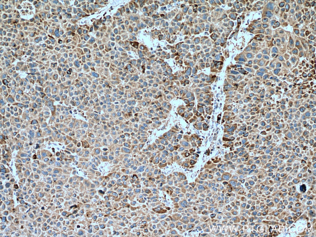 Immunohistochemistry (IHC) staining of human liver cancer tissue using ACSM5 Monoclonal antibody (67334-1-Ig)