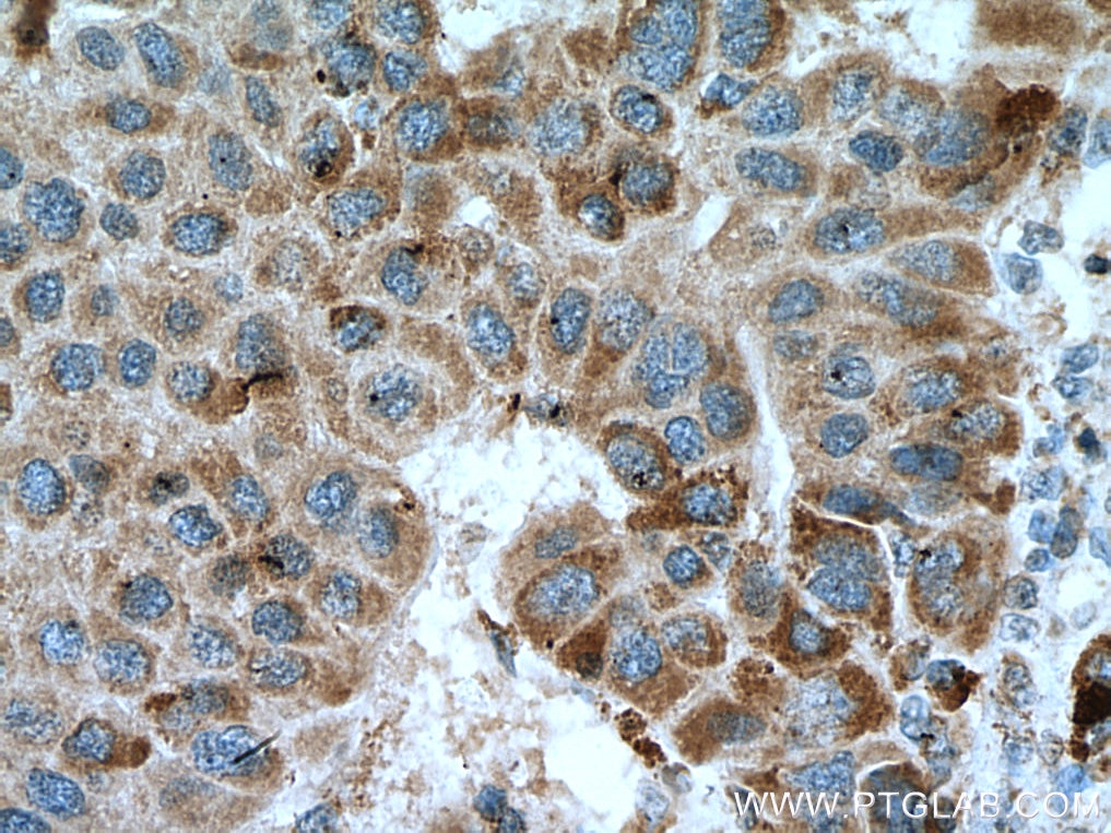 Immunohistochemistry (IHC) staining of human liver cancer tissue using ACSM5 Monoclonal antibody (67334-1-Ig)