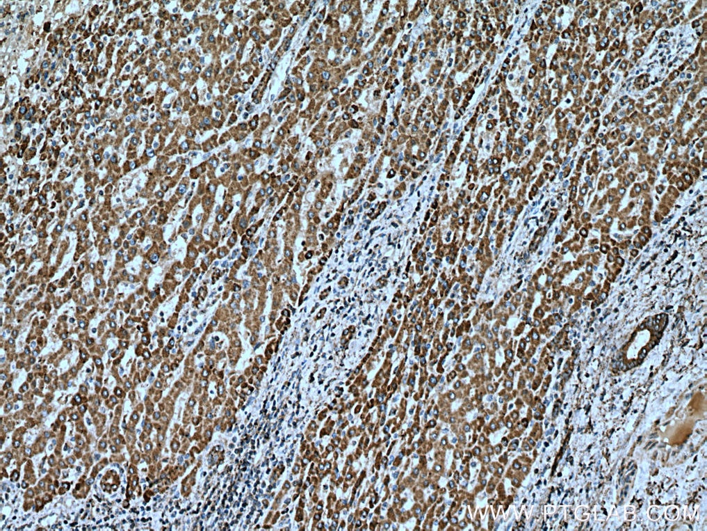 Immunohistochemistry (IHC) staining of human liver cancer tissue using ACSM5 Monoclonal antibody (67334-1-Ig)
