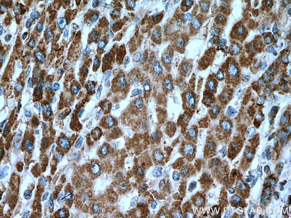 Immunohistochemistry (IHC) staining of human liver cancer tissue using ACSM5 Monoclonal antibody (67334-1-Ig)