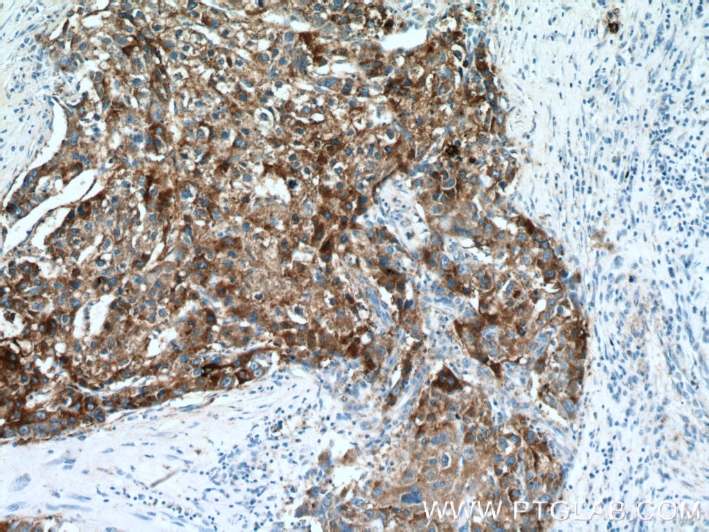 Immunohistochemistry (IHC) staining of human liver cancer tissue using ACSS1 Polyclonal antibody (17138-1-AP)