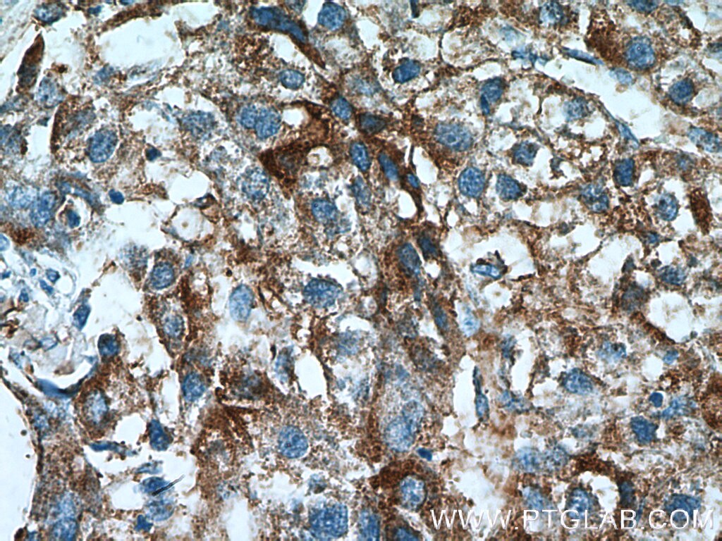 Immunohistochemistry (IHC) staining of human liver cancer tissue using ACSS1 Polyclonal antibody (17138-1-AP)