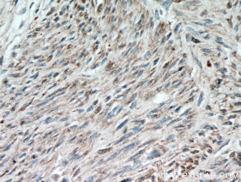 Immunohistochemistry (IHC) staining of human hysteromyoma tissue using ACTA1-Specific Polyclonal antibody (17521-1-AP)