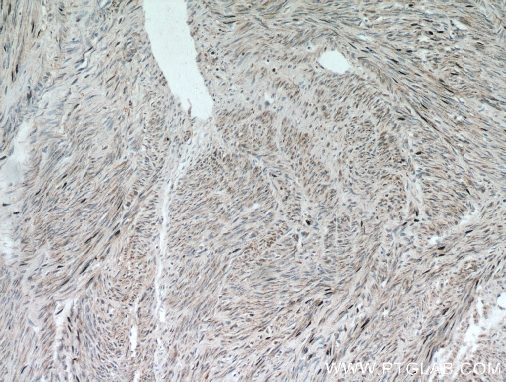 Immunohistochemistry (IHC) staining of human hysteromyoma tissue using ACTA1-Specific Polyclonal antibody (17521-1-AP)