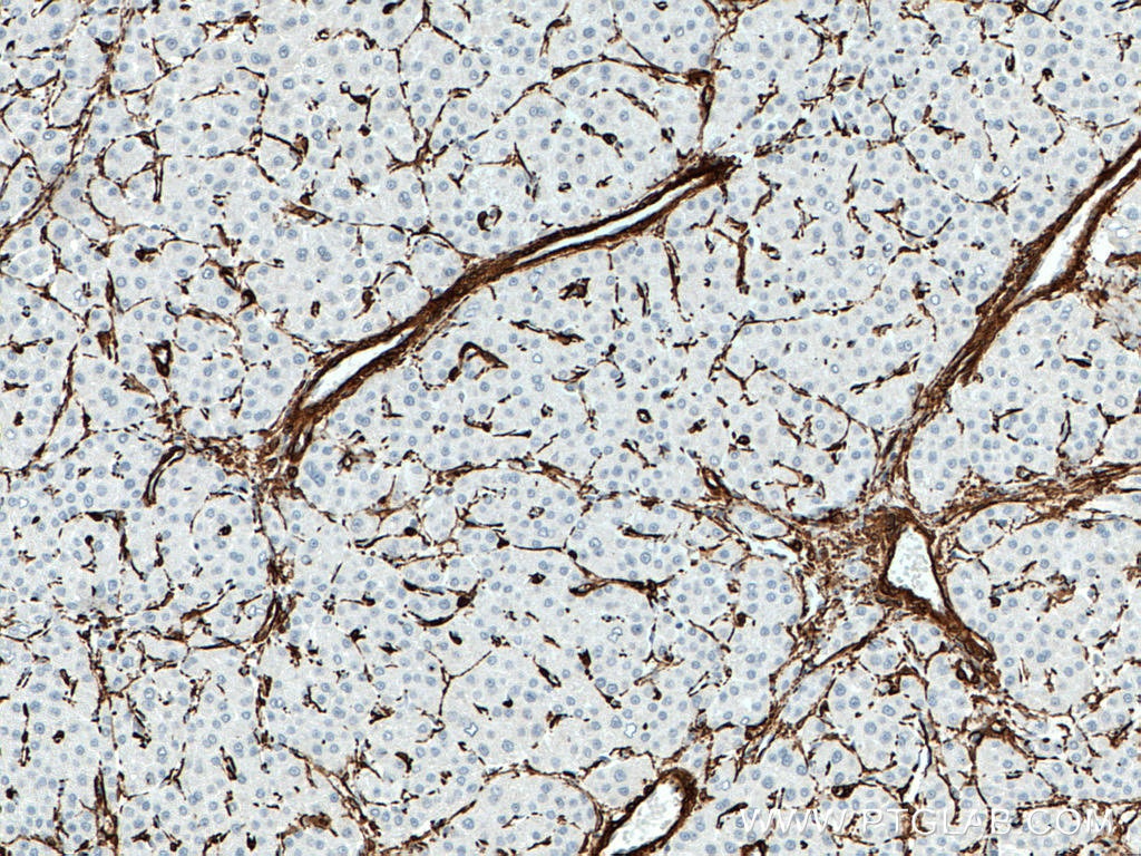 Immunohistochemistry (IHC) staining of human liver cancer tissue using smooth muscle actin Polyclonal antibody (14395-1-AP)