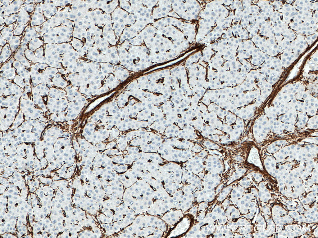 IHC staining of human liver cancer using 14395-1-AP