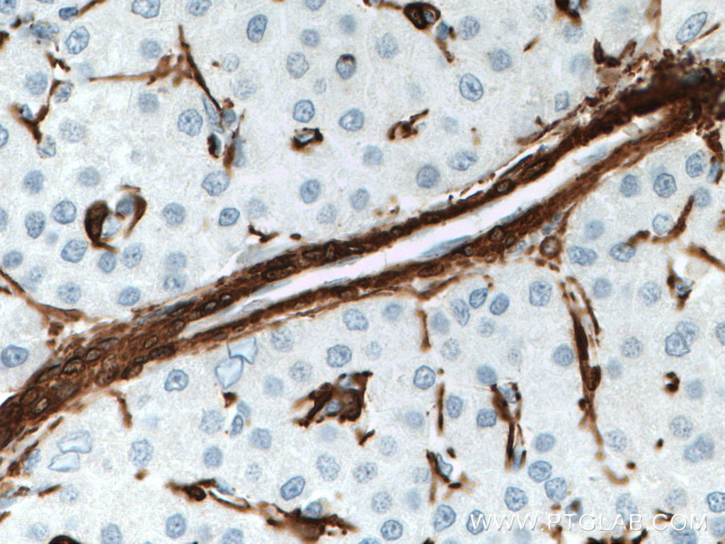 Immunohistochemistry (IHC) staining of human liver cancer tissue using Alpha smooth muscle actin Polyclonal antibody (14395-1-AP)
