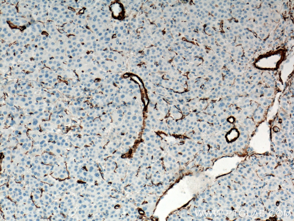 Immunohistochemistry (IHC) staining of human liver cancer tissue using smooth muscle actin Polyclonal antibody (14395-1-AP)