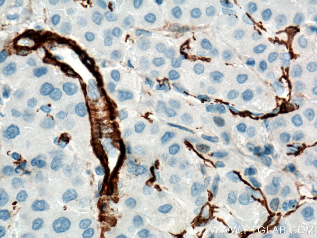 Immunohistochemistry (IHC) staining of human liver cancer tissue using smooth muscle actin Polyclonal antibody (14395-1-AP)