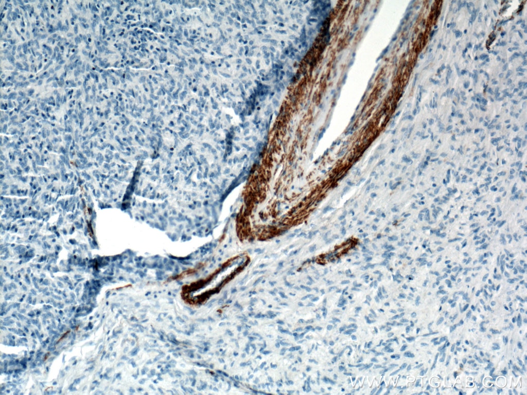 Immunohistochemistry (IHC) staining of stromal tumor tissue using smooth muscle actin Polyclonal antibody (14395-1-AP)