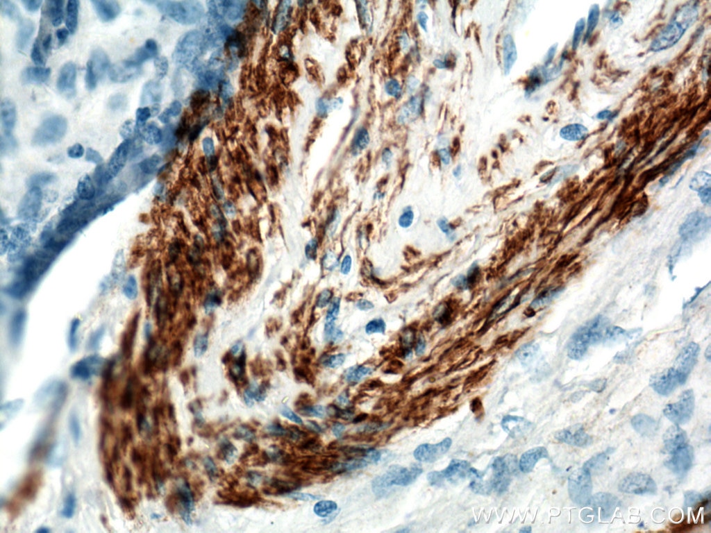 Immunohistochemistry (IHC) staining of stromal tumor tissue using smooth muscle actin Polyclonal antibody (14395-1-AP)