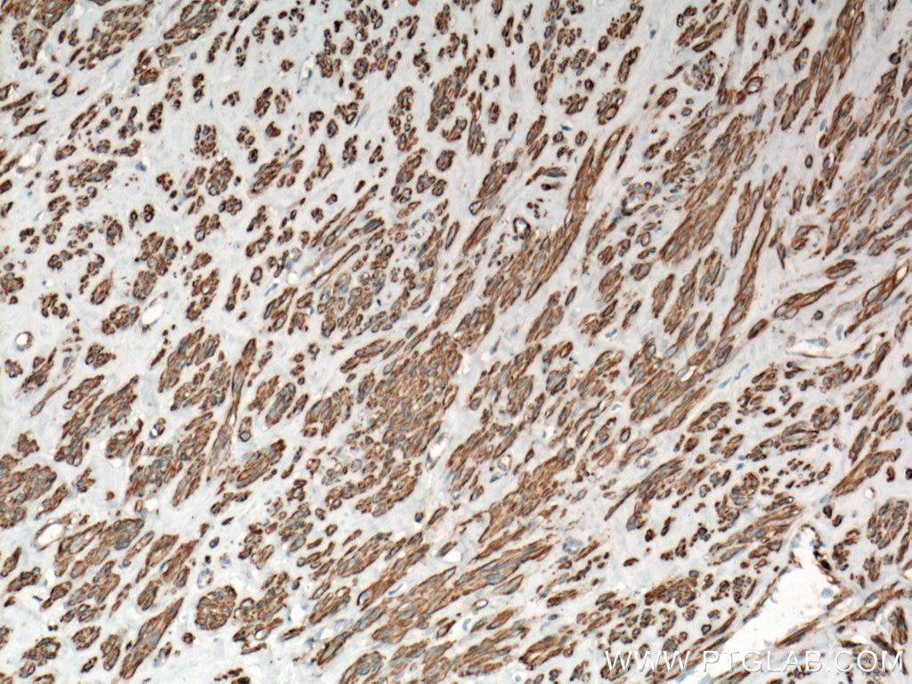 Immunohistochemistry (IHC) staining of human hysteromyoma tissue using smooth muscle actin Polyclonal antibody (14395-1-AP)