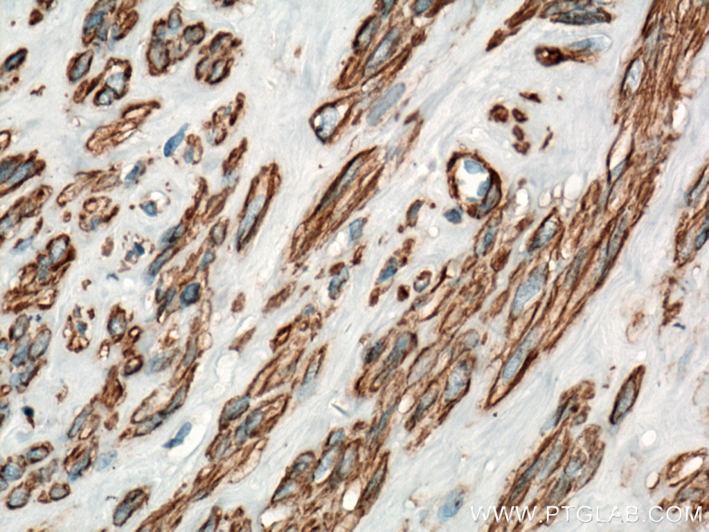 Immunohistochemistry (IHC) staining of human hysteromyoma tissue using smooth muscle actin Polyclonal antibody (14395-1-AP)