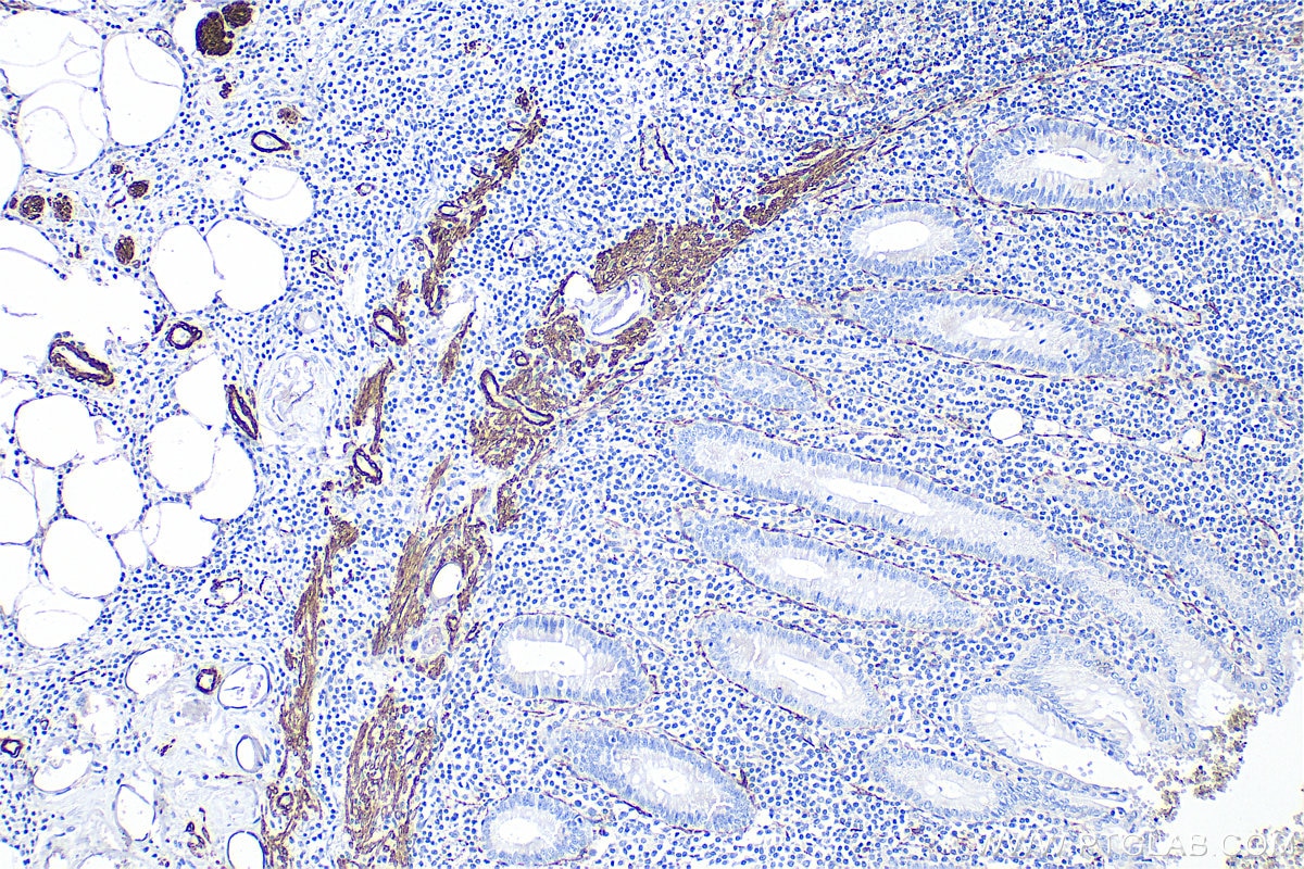 Immunohistochemistry (IHC) staining of human appendicitis tissue using Alpha smooth muscle actin Polyclonal antibody (14395-1-AP)