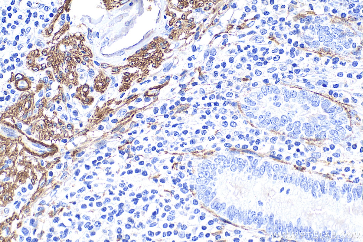 Immunohistochemistry (IHC) staining of human appendicitis tissue using Alpha smooth muscle actin Polyclonal antibody (14395-1-AP)