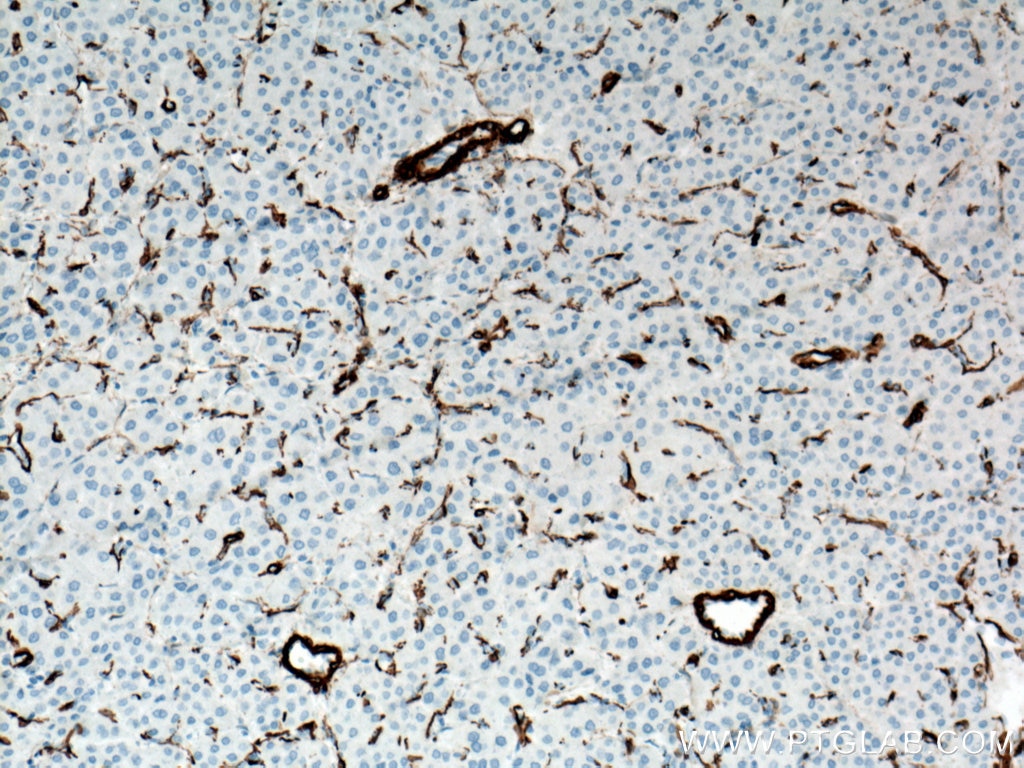 Immunohistochemistry (IHC) staining of human liver cancer tissue using smooth muscle actin Polyclonal antibody (23081-1-AP)
