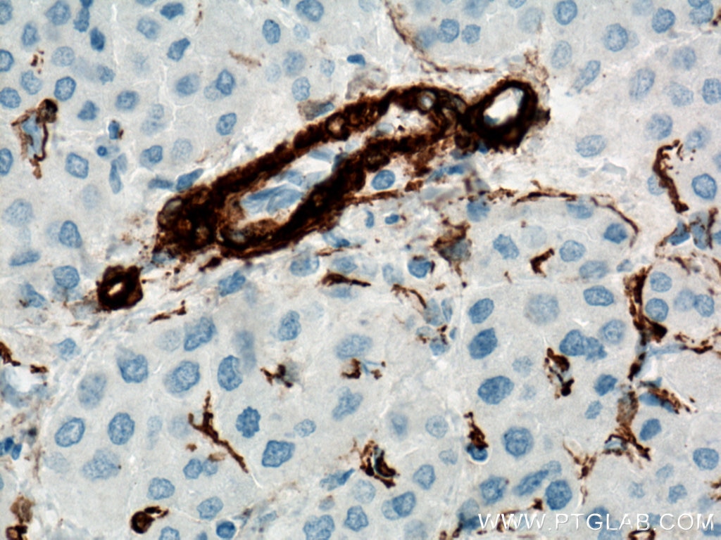 Immunohistochemistry (IHC) staining of human liver cancer tissue using smooth muscle actin Polyclonal antibody (23081-1-AP)