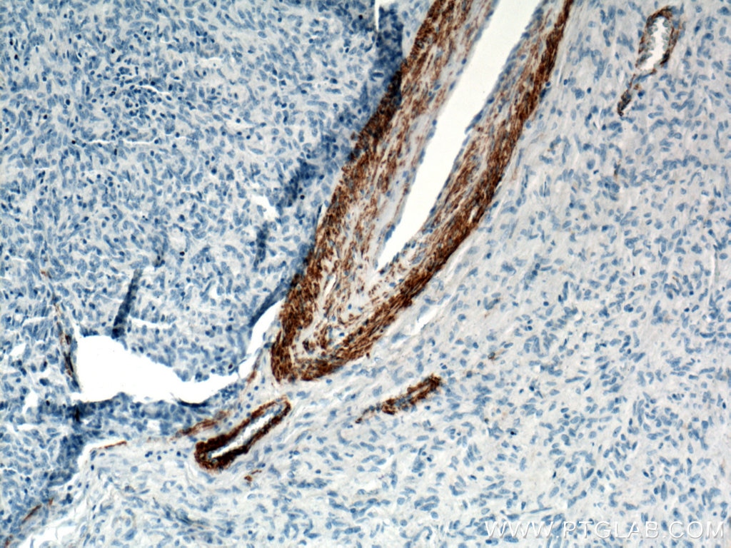 Immunohistochemistry (IHC) staining of stromal tumor tissue using smooth muscle actin Polyclonal antibody (23081-1-AP)