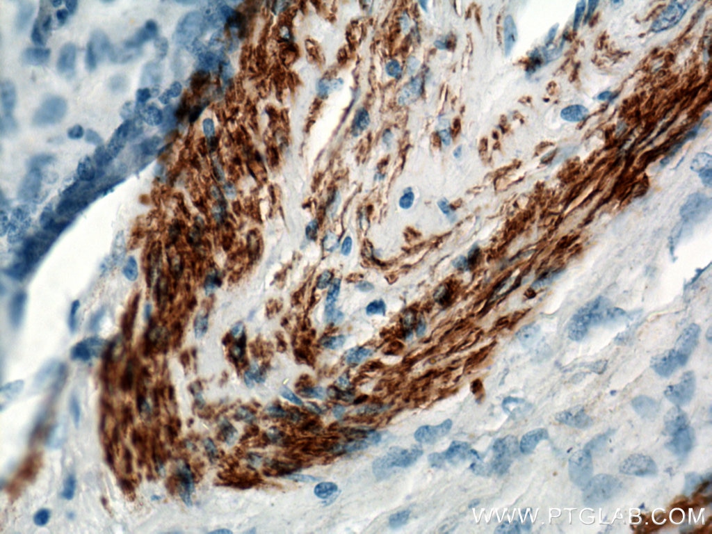 Immunohistochemistry (IHC) staining of stromal tumor tissue using smooth muscle actin Polyclonal antibody (23081-1-AP)