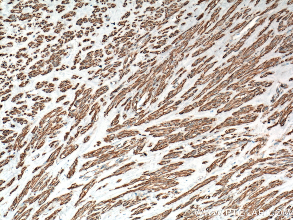 Immunohistochemistry (IHC) staining of human hysteromyoma tissue using smooth muscle actin Polyclonal antibody (23081-1-AP)