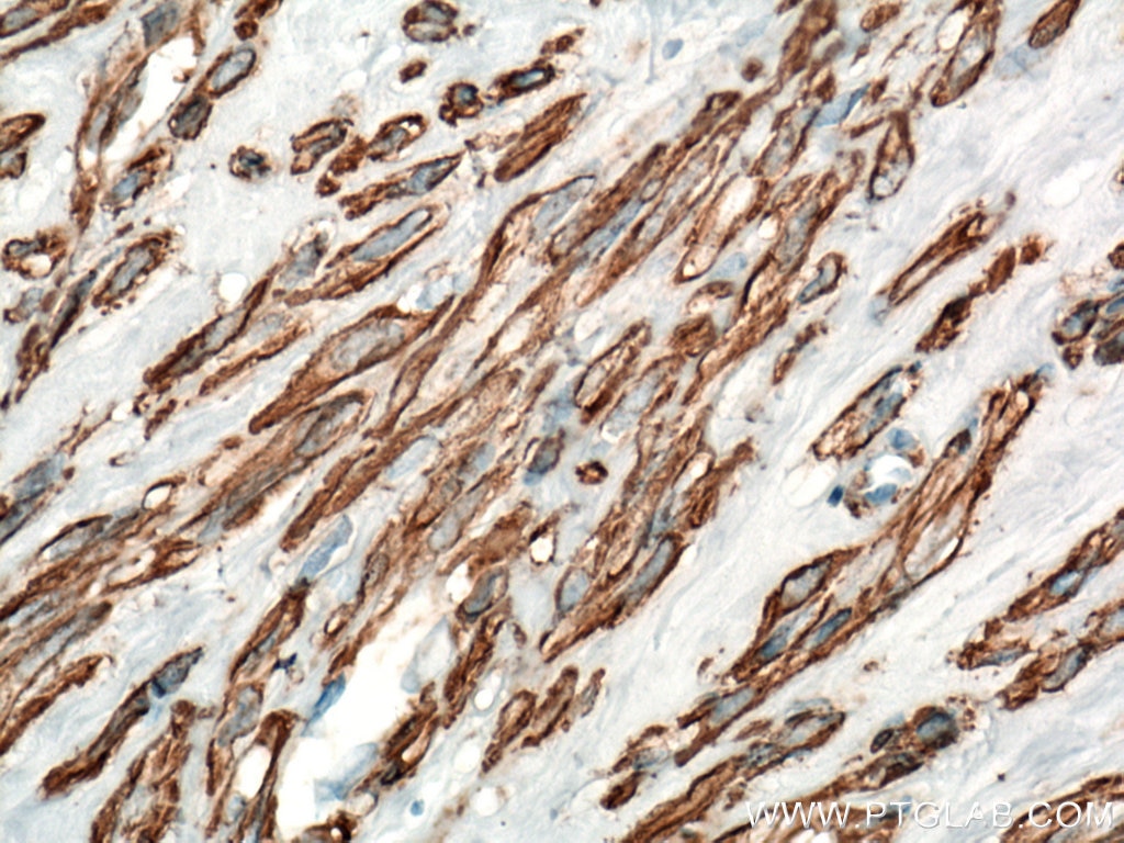 Immunohistochemistry (IHC) staining of human hysteromyoma tissue using smooth muscle actin Polyclonal antibody (23081-1-AP)