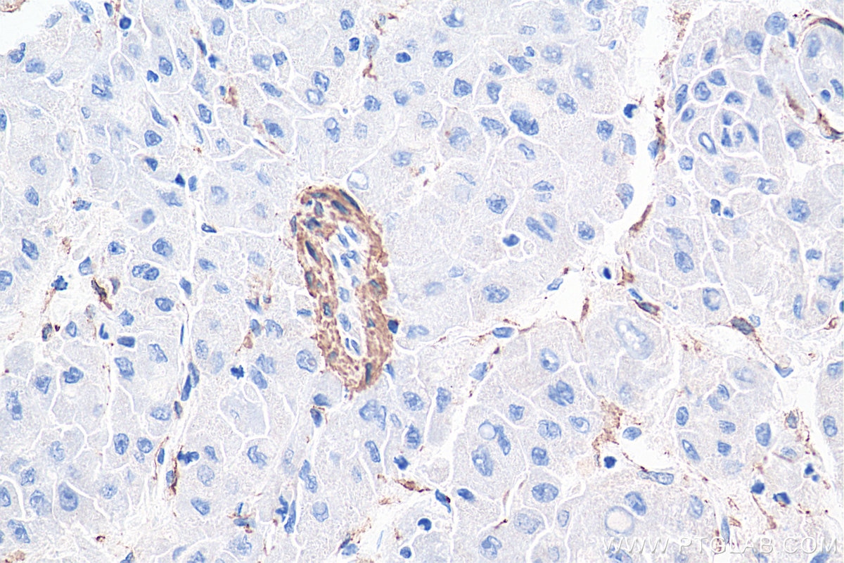 Immunohistochemistry (IHC) staining of human liver cancer tissue using smooth muscle actin specific Polyclonal antibody (55135-1-AP)