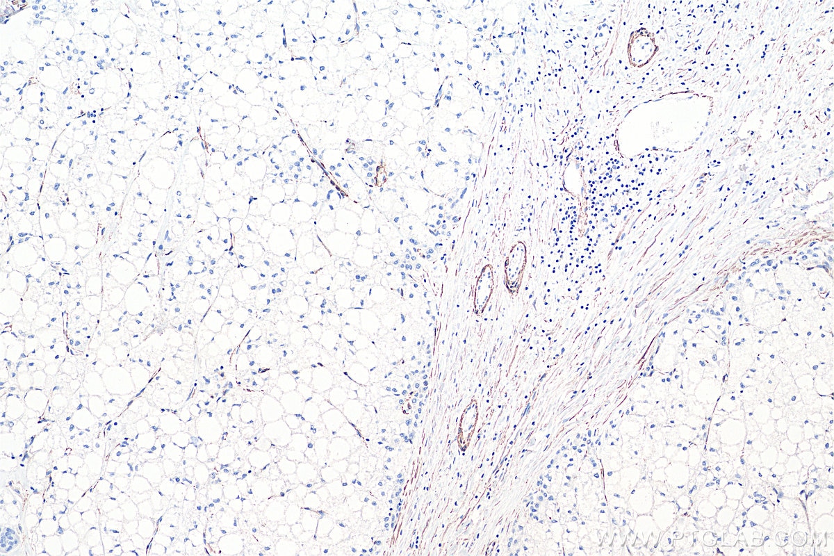 Immunohistochemistry (IHC) staining of human liver cancer tissue using smooth muscle actin specific Polyclonal antibody (55135-1-AP)