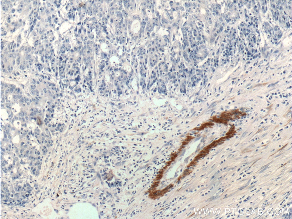 Immunohistochemistry (IHC) staining of human colon cancer tissue using smooth muscle actin specific Polyclonal antibody (55135-1-AP)