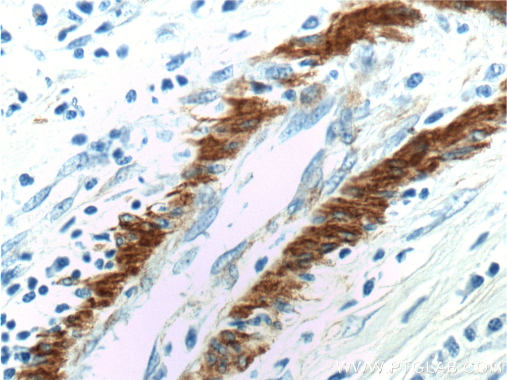 IHC staining of human colon cancer using 55135-1-AP