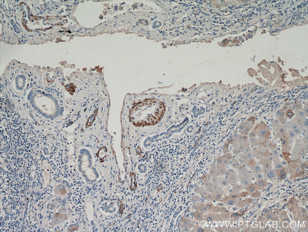 Immunohistochemistry (IHC) staining of human hepatocirrhosis tissue using smooth muscle actin specific Polyclonal antibody (55135-1-AP)
