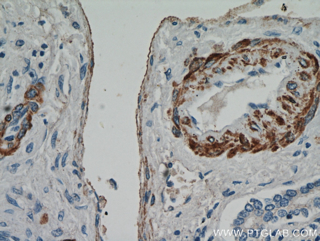 Immunohistochemistry (IHC) staining of human hepatocirrhosis tissue using smooth muscle actin specific Polyclonal antibody (55135-1-AP)