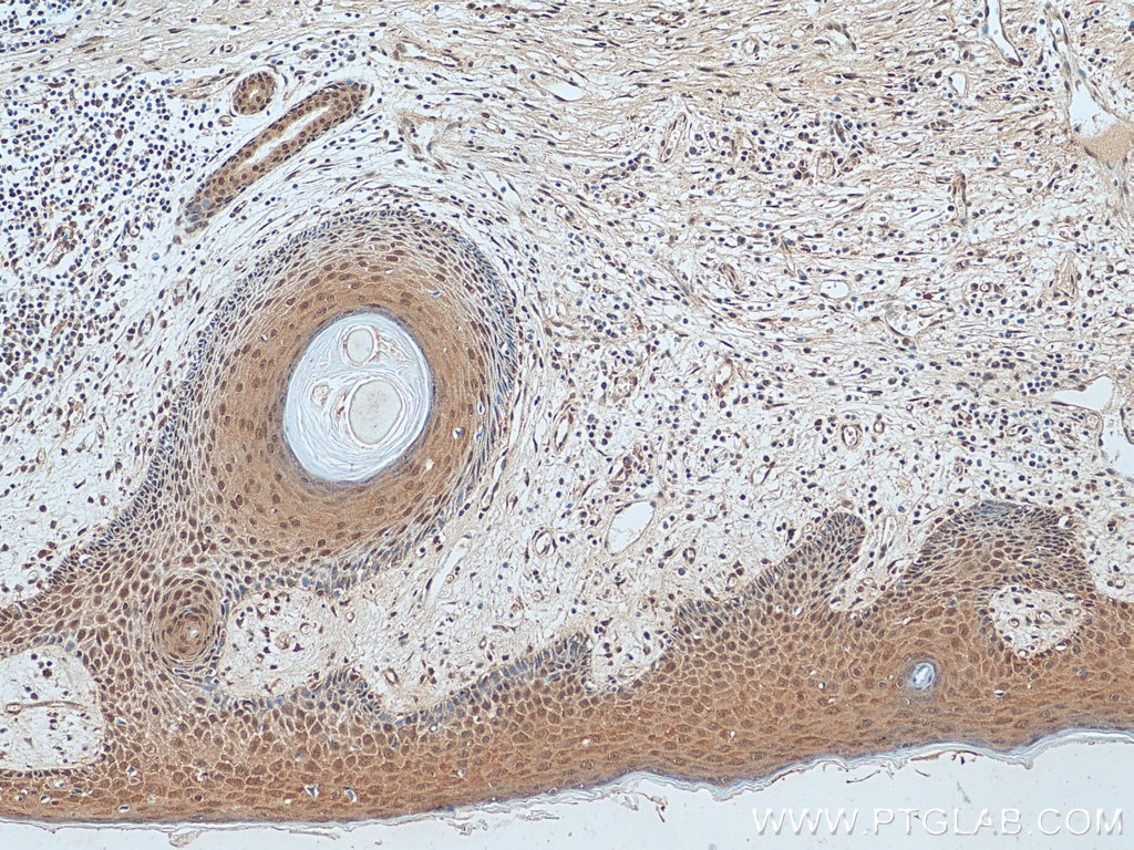 IHC staining of human skin cancer using 10341-1-AP