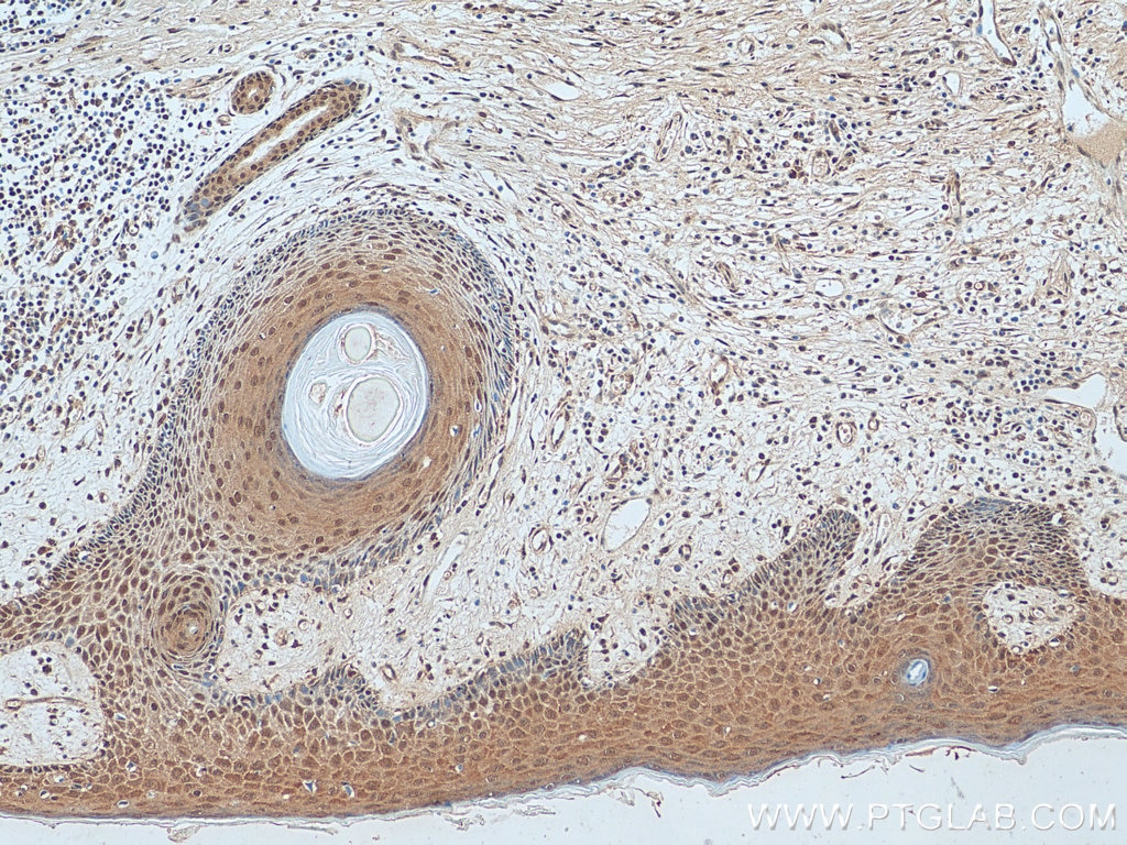 Immunohistochemistry (IHC) staining of human skin cancer tissue using ACTL6A Polyclonal antibody (10341-1-AP)