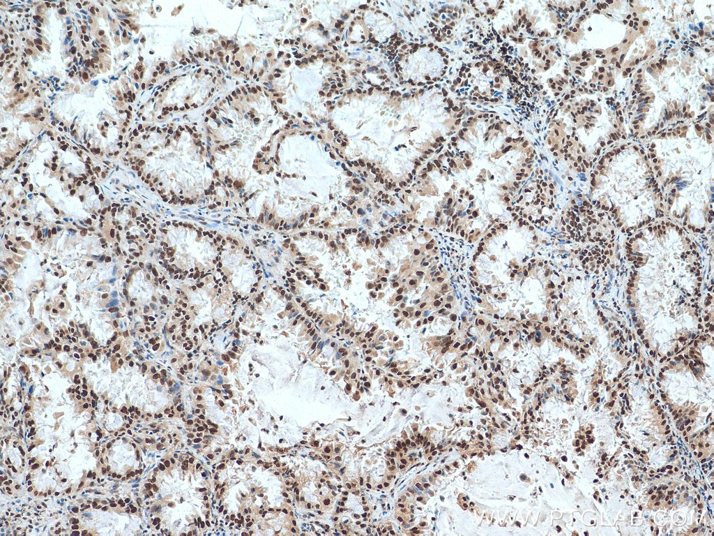 Immunohistochemistry (IHC) staining of human lung cancer tissue using ACTL6A Polyclonal antibody (10341-1-AP)