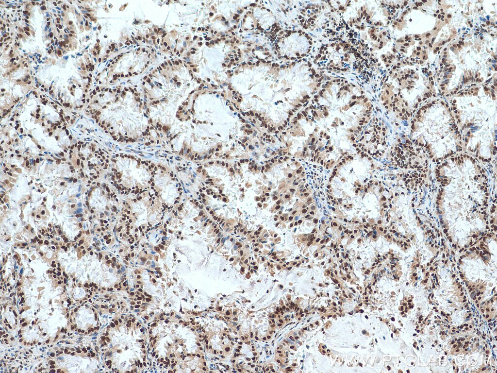 Immunohistochemistry (IHC) staining of human lung cancer tissue using ACTL6A Polyclonal antibody (10341-1-AP)