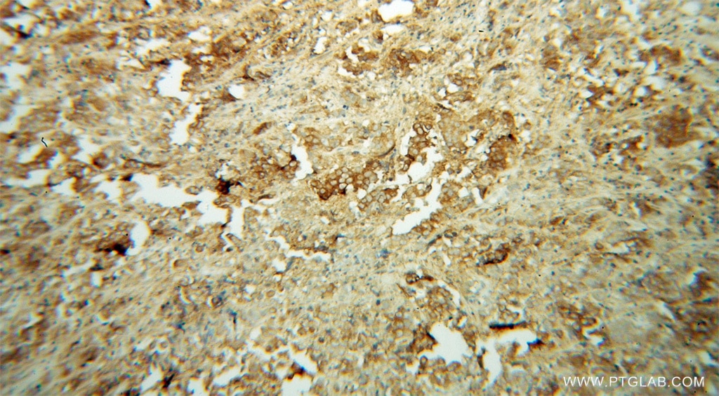 Immunohistochemistry (IHC) staining of human prostate cancer tissue using ACTL7B Polyclonal antibody (13537-1-AP)
