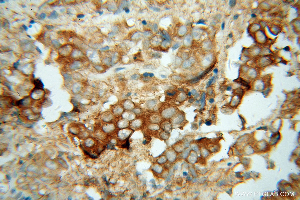 Immunohistochemistry (IHC) staining of human prostate cancer tissue using ACTL7B Polyclonal antibody (13537-1-AP)