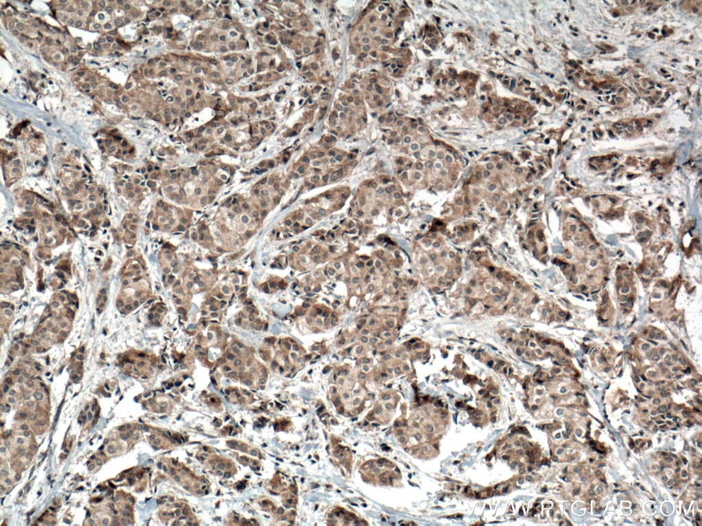 Immunohistochemistry (IHC) staining of human breast cancer tissue using ACTN3 Polyclonal antibody (24378-1-AP)