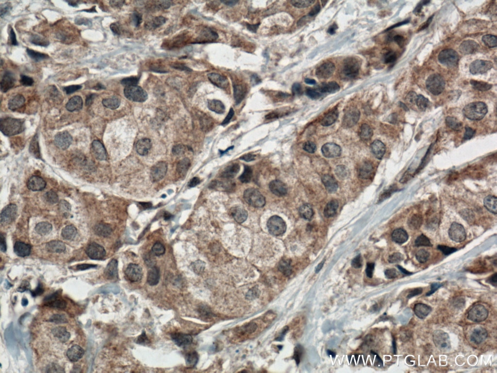 Immunohistochemistry (IHC) staining of human breast cancer tissue using ACTN3 Polyclonal antibody (24378-1-AP)