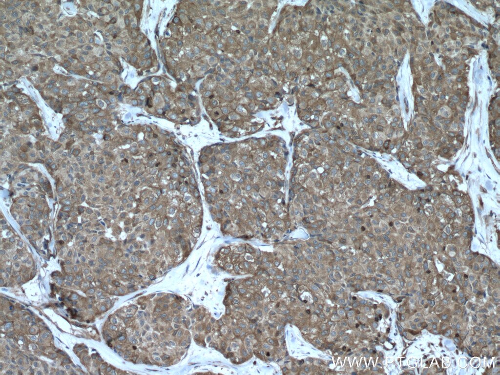 Immunohistochemistry (IHC) staining of human lung cancer tissue using ACTN4 Polyclonal antibody (19096-1-AP)