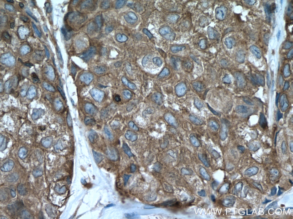 Immunohistochemistry (IHC) staining of human lung cancer tissue using ACTN4 Polyclonal antibody (19096-1-AP)