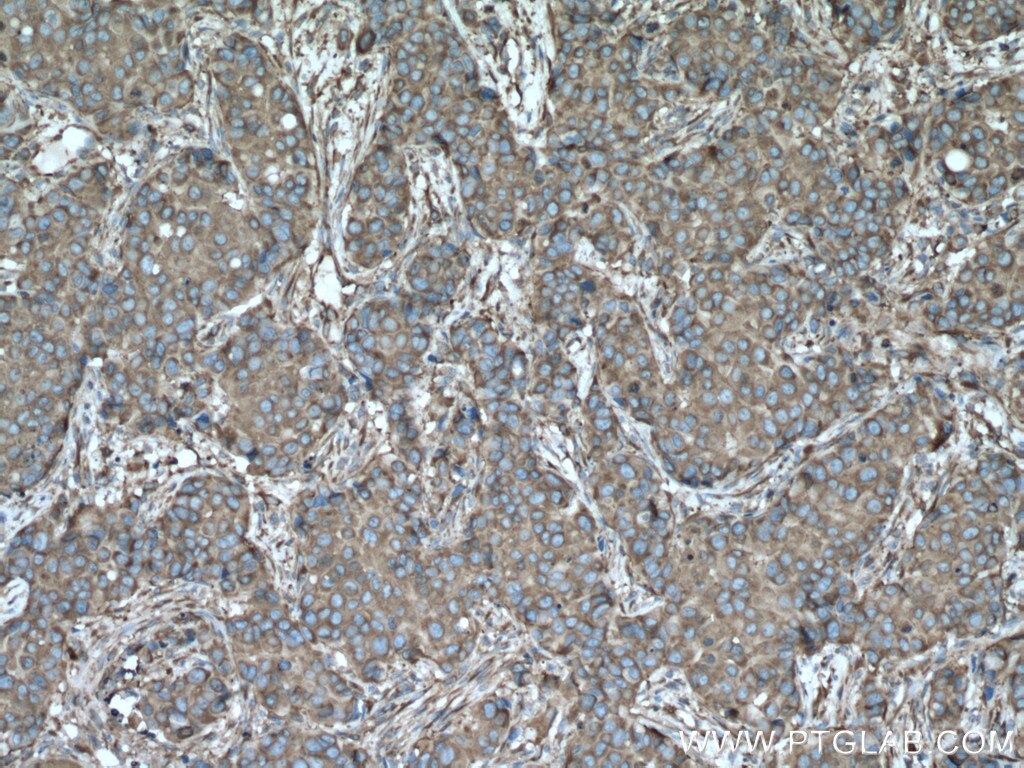 Immunohistochemistry (IHC) staining of human breast cancer tissue using ACTN4 Polyclonal antibody (19096-1-AP)