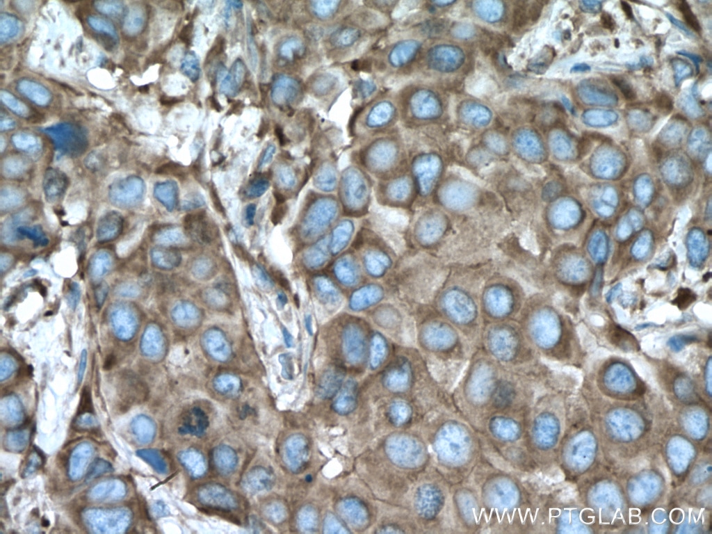 Immunohistochemistry (IHC) staining of human breast cancer tissue using ACTN4 Polyclonal antibody (19096-1-AP)