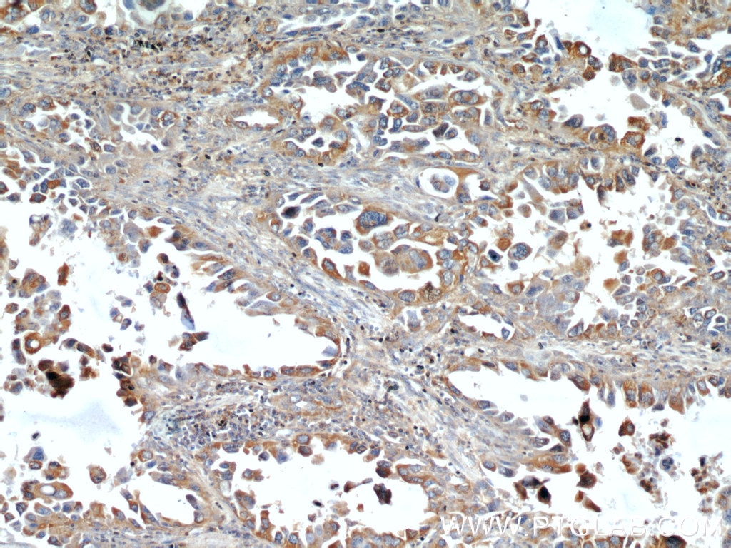 IHC staining of human lung cancer using 19096-1-AP