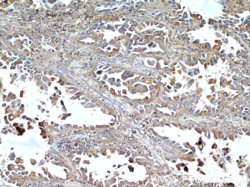 Immunohistochemistry (IHC) staining of human lung cancer tissue using ACTN4 Polyclonal antibody (19096-1-AP)