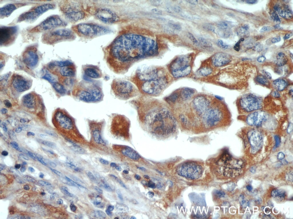 IHC staining of human lung cancer using 19096-1-AP